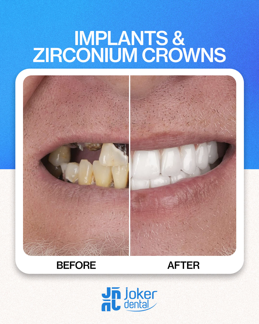 İsdentbul Before After 8