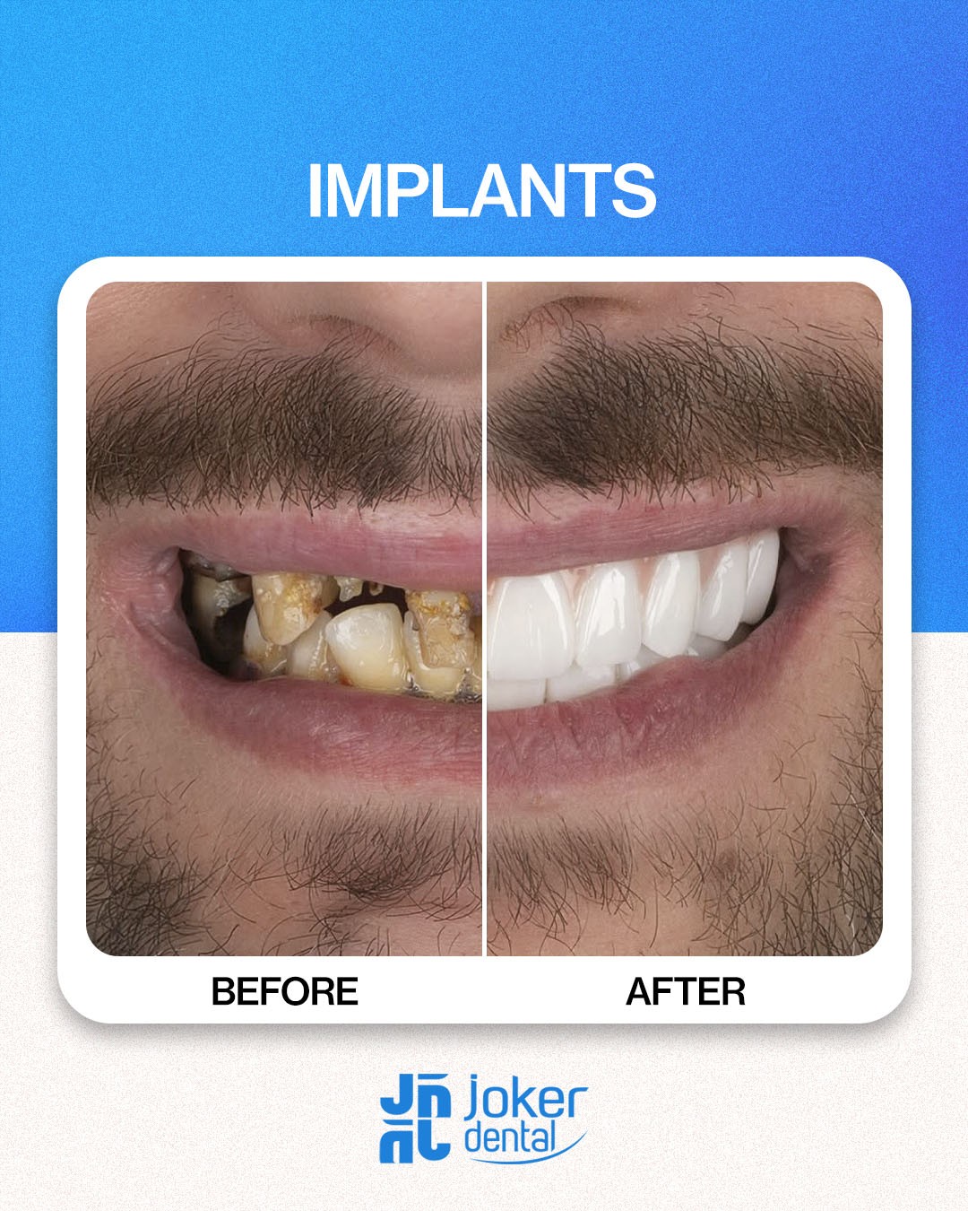 İsdentbul Before After 4